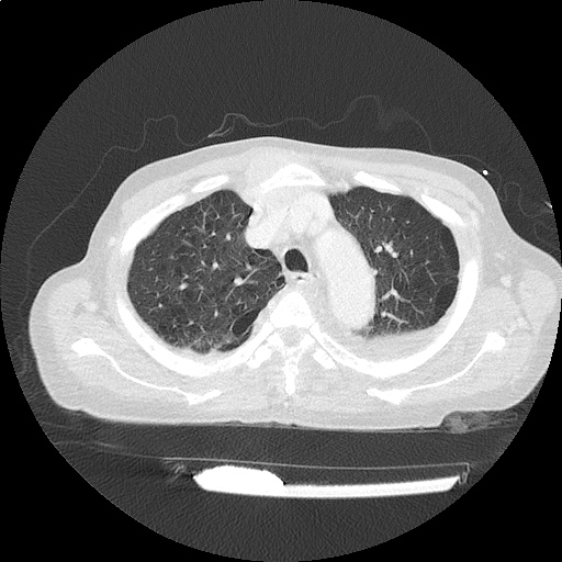 ct_chest_anemia_04